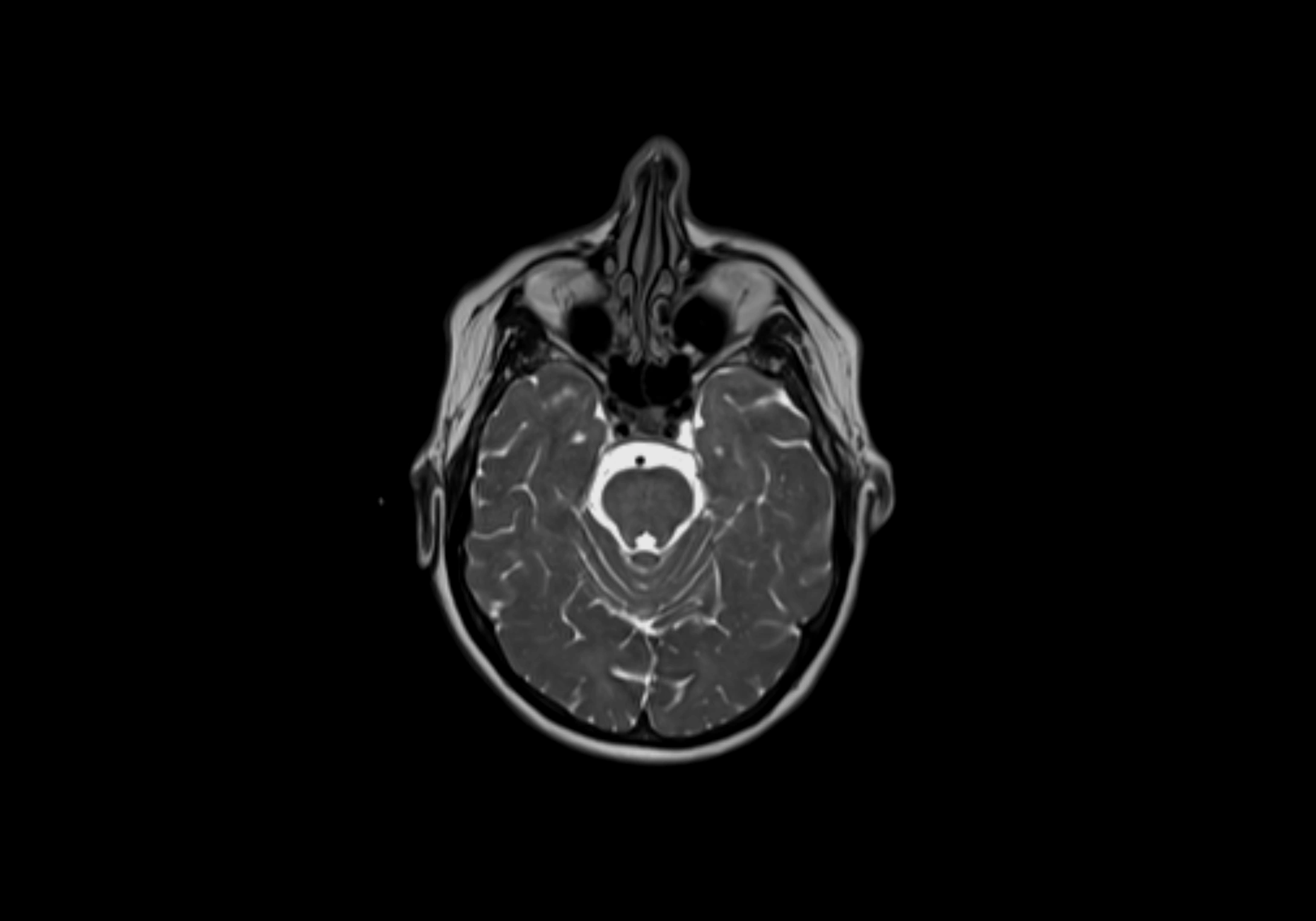 Neck axial  lymph node cross sectional MRI anatomy 3T MRI  image-img-00001-00009.webp